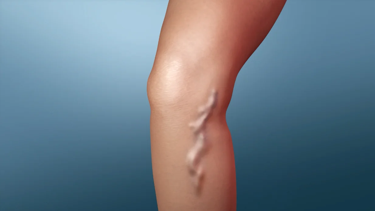 Varicose Veins Treated by Vascular Doctors in Baltimore - Mercy