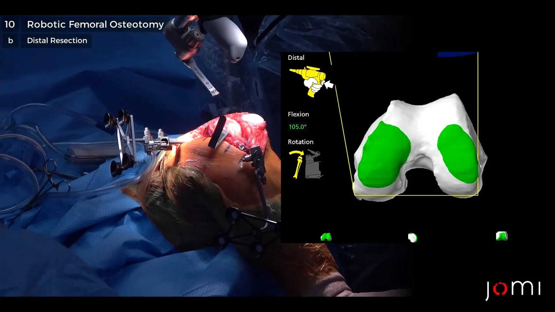 stryker mako robotic knee surgery