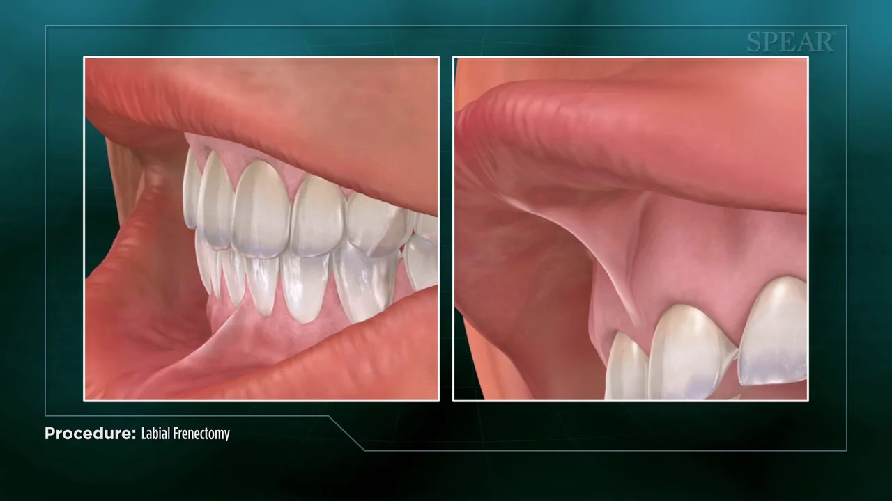 Laser Frenectomy Lower Lip Recovery