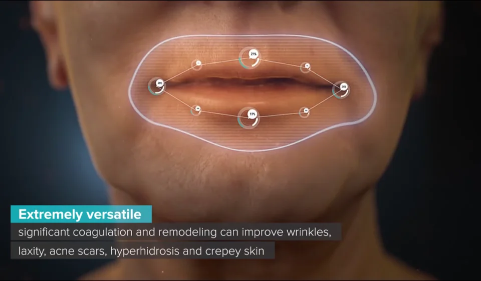 Genius Microneedling With Rf Rebecca Fitzgerald Md Genius Microneedling With Rf Rebecca Fitzgerald Md