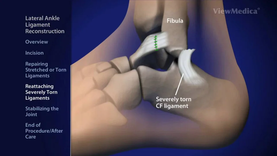 Lateral Ankle Ligament Reconstruction | ALR | Arizona Lateral Ankle Ligament Reconstruction | ALR | Arizona