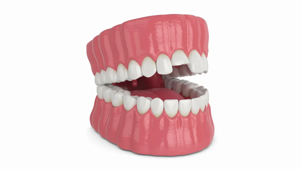 Dental Bonding Video  Tooth Bonding 