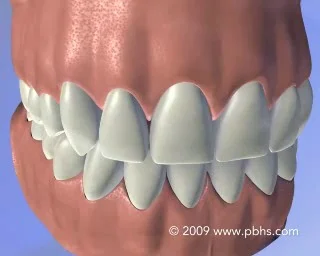 Teeth Whitening Brooklyn Ny Teeth Bleaching Dental Whitening