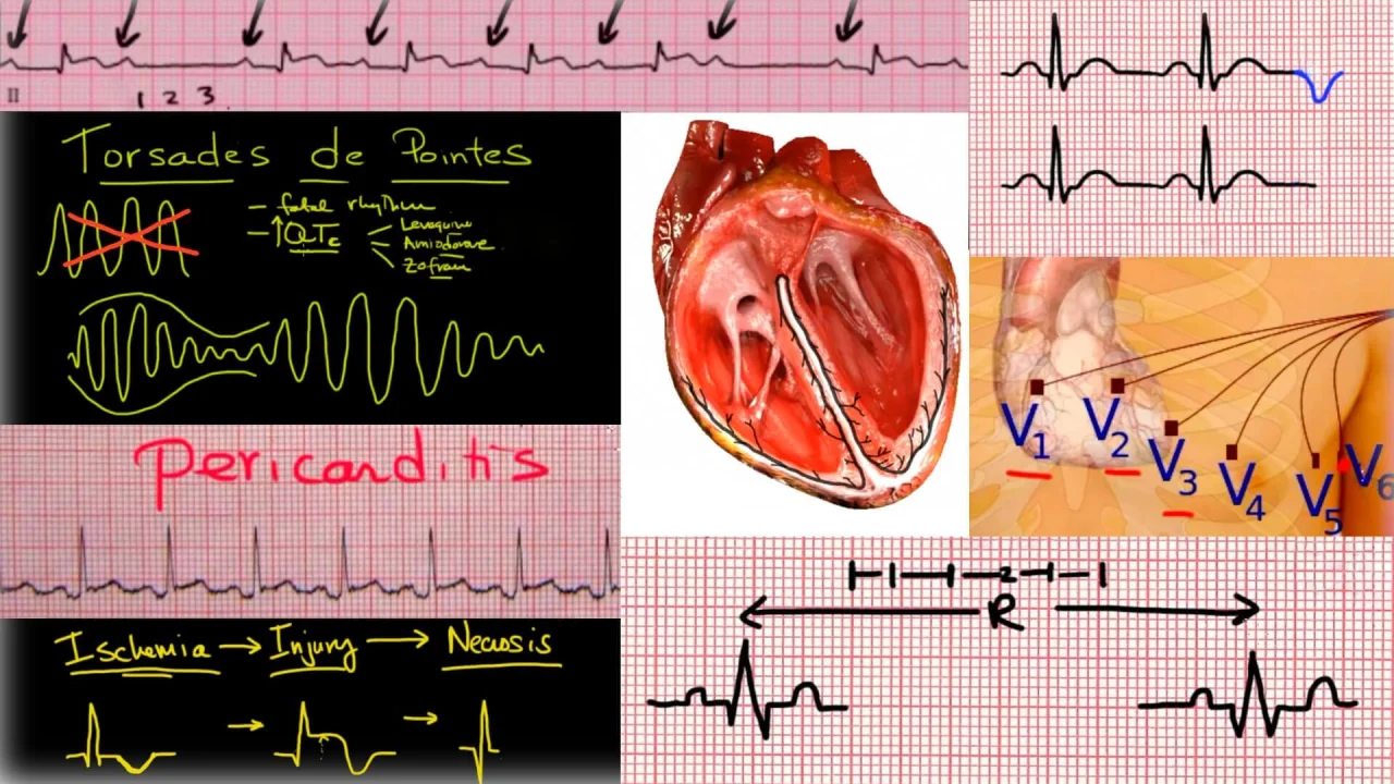 Ecg Interpretation Simplified The Online Ekg Course Cme