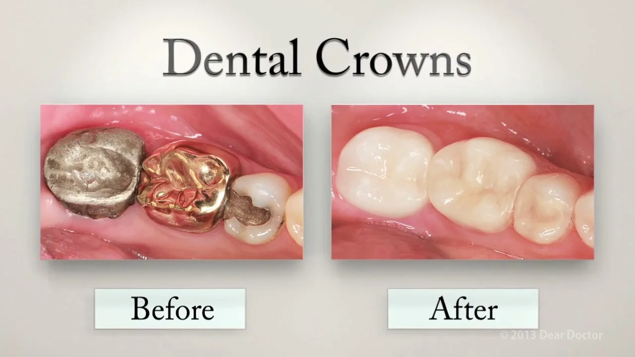 Dental Crowns And Onlays Genuine Dental Arts