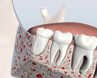 Video Thumbnail for wisdom teeth removal informative animation