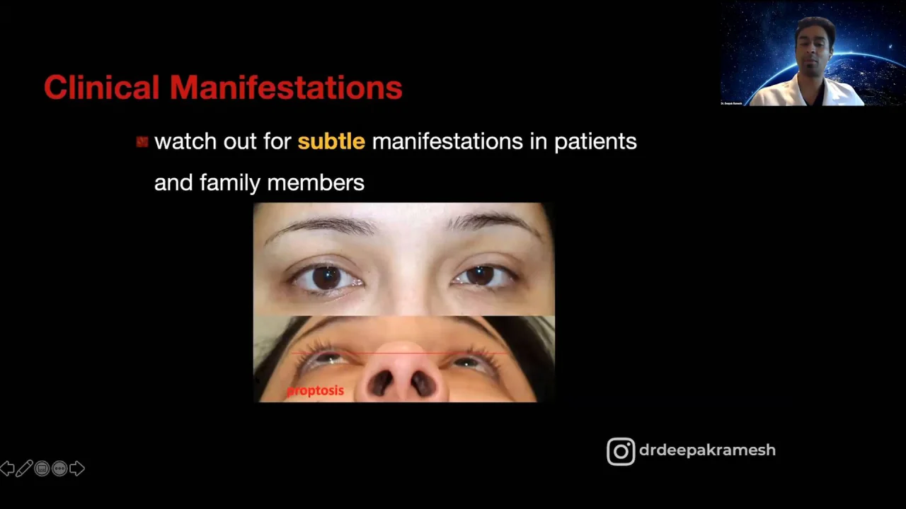 Lecture Thyroid Eye Disease Past Present And Future Cybersight Lecture Thyroid Eye Disease Past Present And Future Cybersight