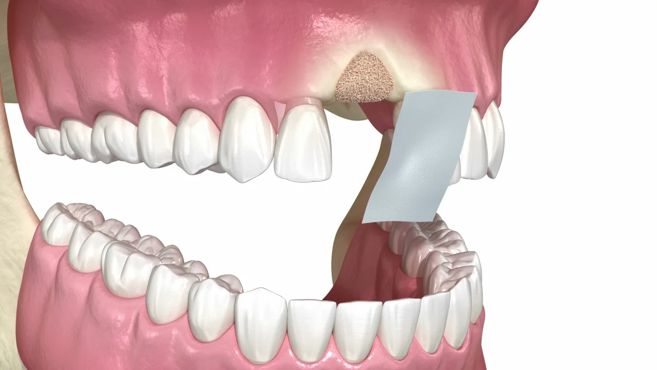 Dental Implant Bone Graft  Bone Grafting for Dental Implant