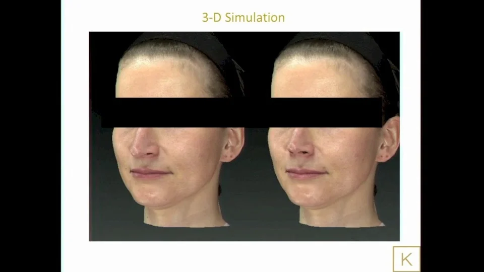 3d Simulation Einer Nasenoperation Nasenkorrektur Plastische Chirurgie Zentrum Fur Asthetische Medizin Wien