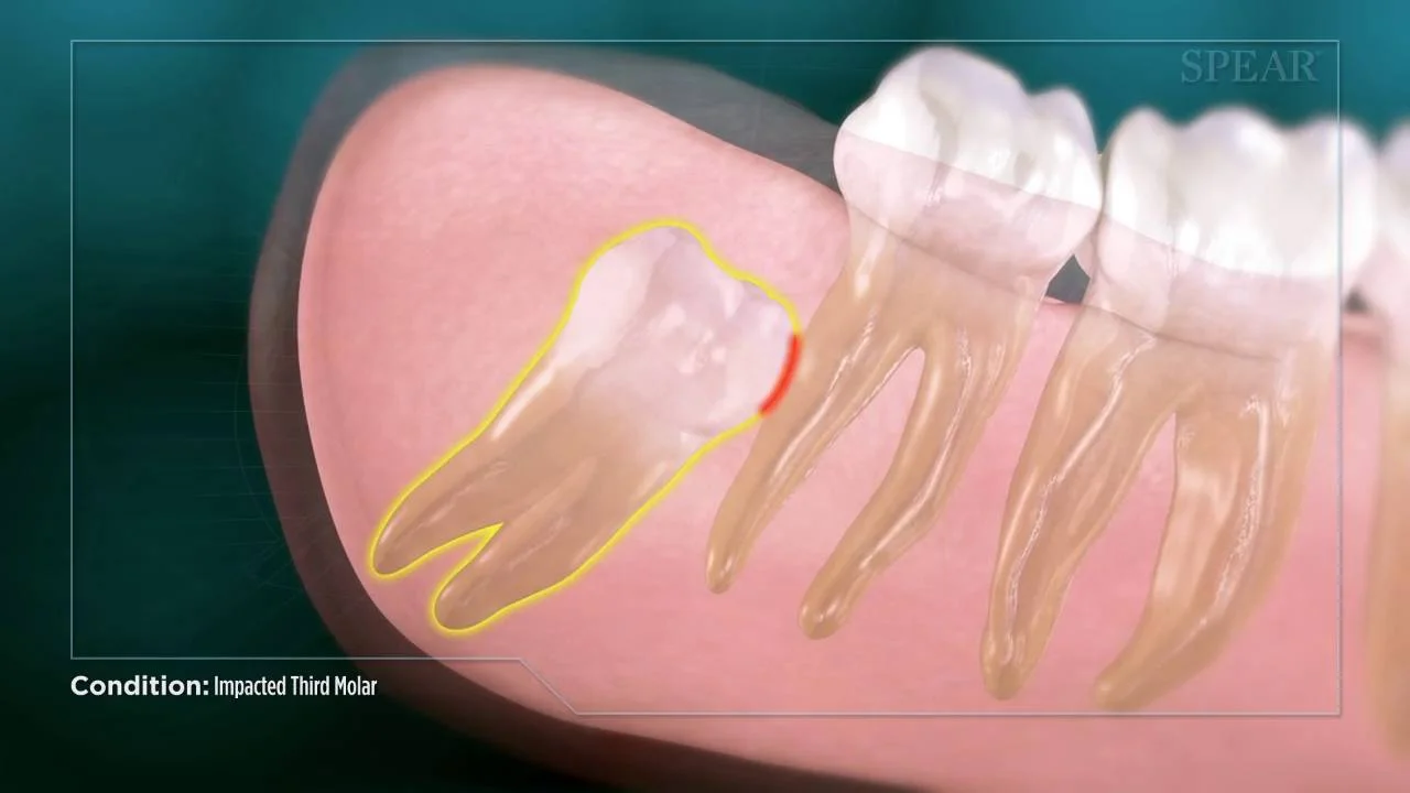 Wisdom Tooth Extraction In Chicago Chicago Wisdom Tooth Extraction Chicago Oral Surgery