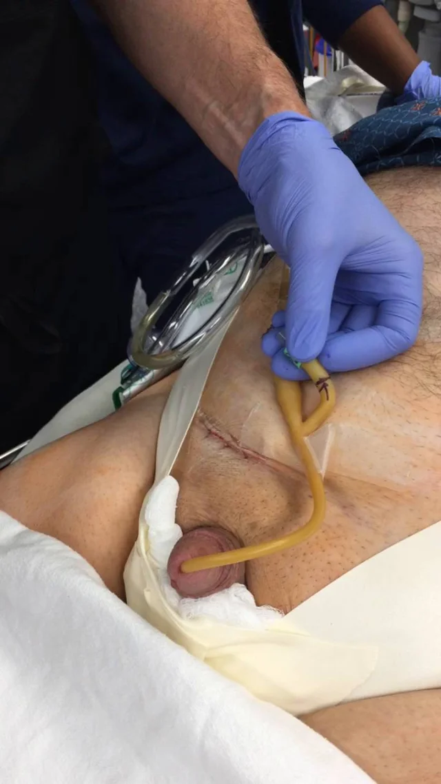 Foley Catheter How To Remove Your After Surgery By Jeff Brady Md Facs Vidscrip Foley Catheter How To Remove Your